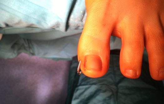 Minimal invasive Hallux Valgus OP?